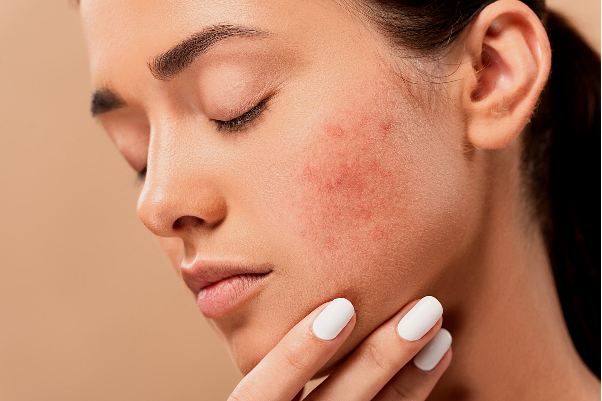 What acne reveals about your health? | Top 6 things