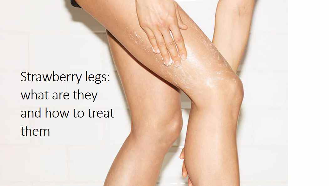 Strawberry legs: what are they and how to treat them