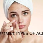 Different types of acne: Treatment & Food