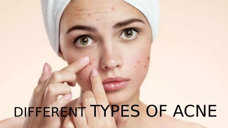Different types of acne: Treatment & Food