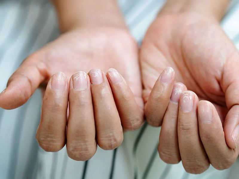 Best Home Remedies For Dry Brittle Nails